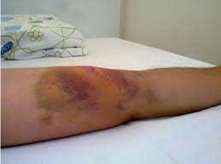 Result of injuries to students from ineffective physical restraint